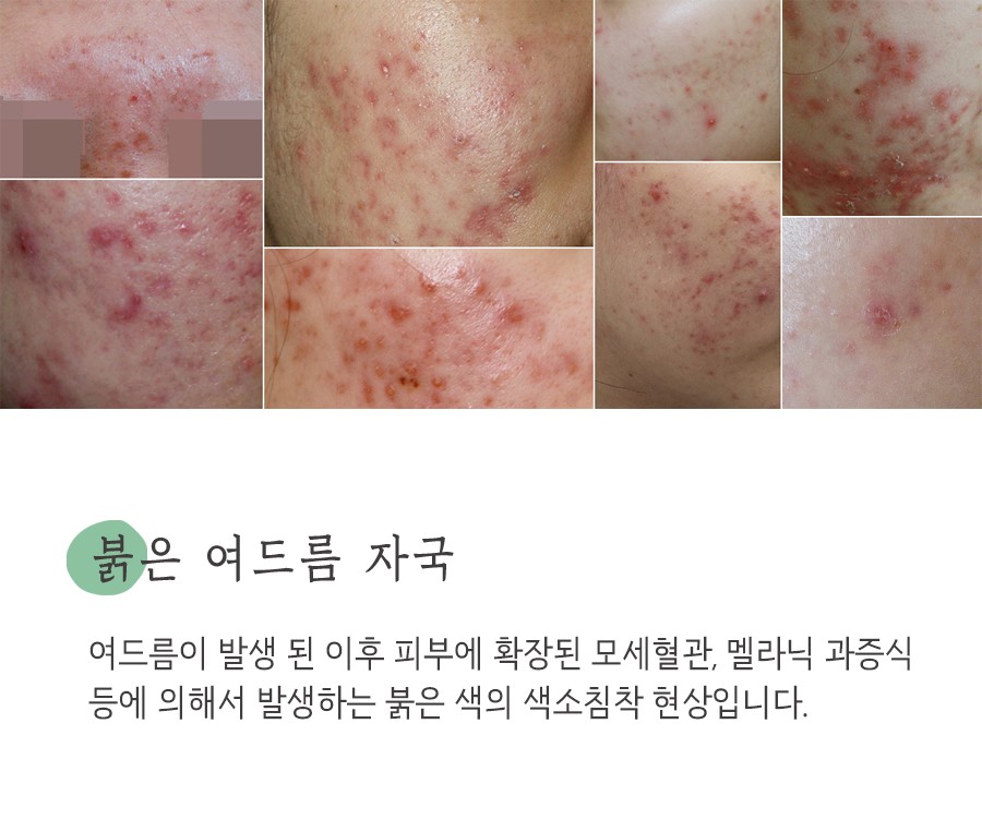 [수원점] 수원여드름자국 미세약초침 치료 후 주의해야 하는 부분은? - 해율한의원