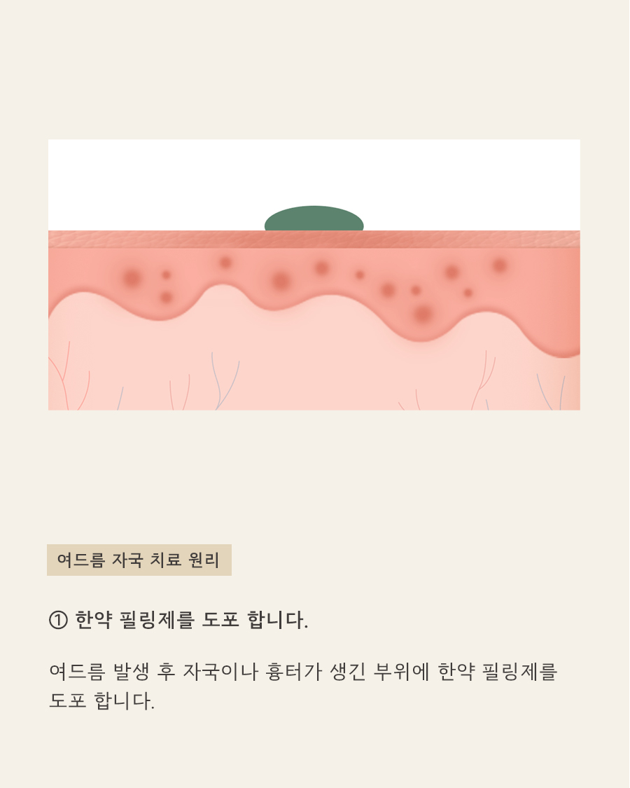 [목동점] 목동여드름자국 쉽게 옅어지지 않는 이유는? - 해율한의원