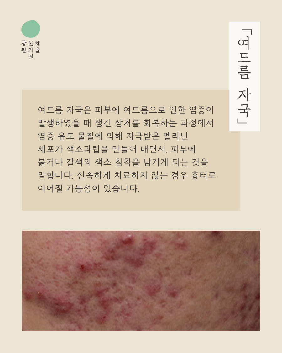 [창원점] 여드름자국 미세약초침 시술 필요한 이유 창원해율한의원과 알아봐요 - 해율한의원