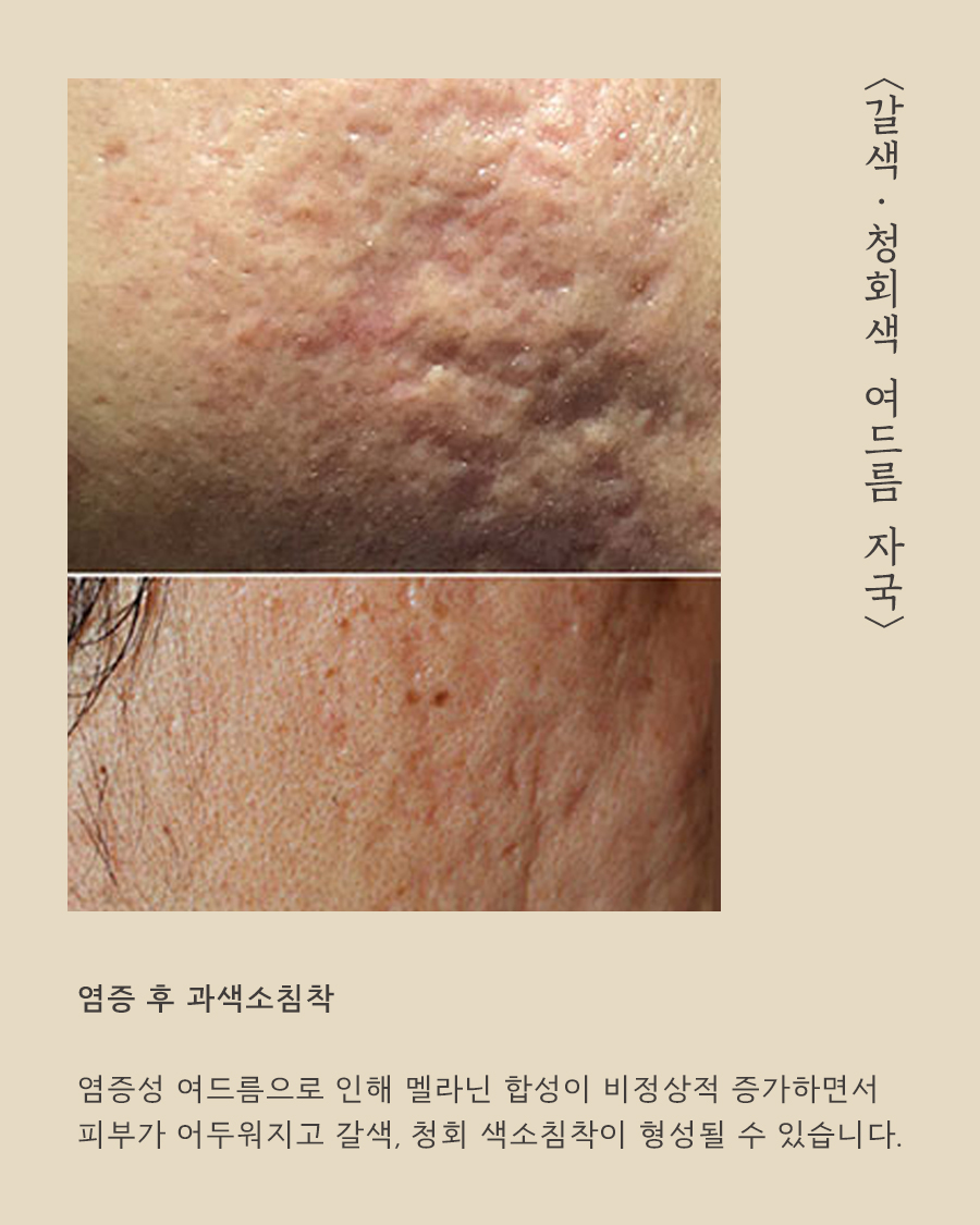 [창원점] 여드름자국 미세약초침 시술 필요한 이유 창원해율한의원과 알아봐요 - 해율한의원