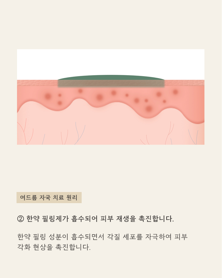 [창원점] 여드름자국 미세약초침 시술 필요한 이유 창원해율한의원과 알아봐요 - 해율한의원