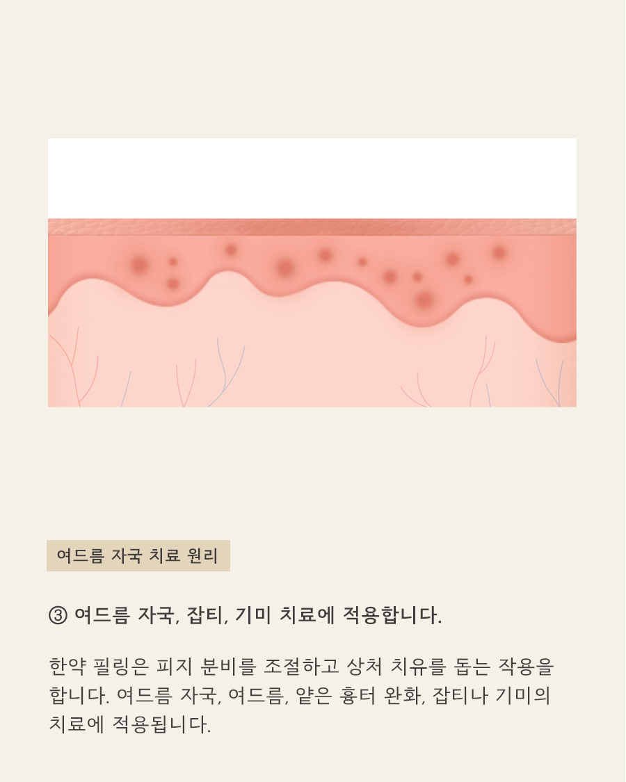 [창원점] 여드름자국 미세약초침 시술 필요한 이유 창원해율한의원과 알아봐요 - 해율한의원