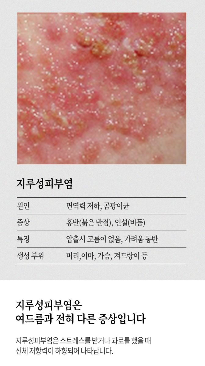 [분당점] 지루성피부염 붉고 가려운 이유, 치료까지 분당 해율한의원이 설명드립니다 - 해율한의원
