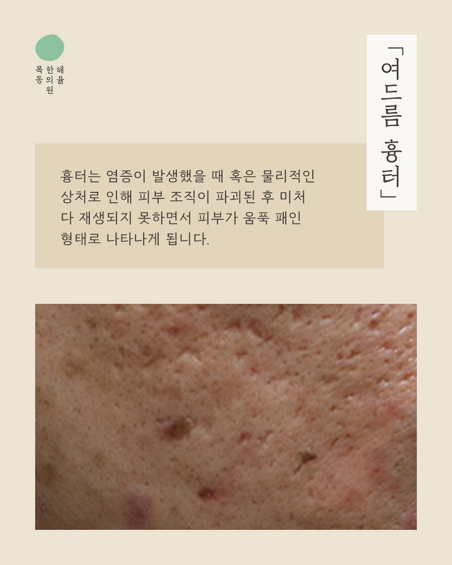 [목동점] 여드름 흉터가 반복되는 내부적·외부적 원인은 무엇인가요? - 해율한의원
