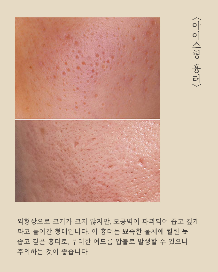 [목동점] 여드름 흉터가 반복되는 내부적·외부적 원인은 무엇인가요? - 해율한의원