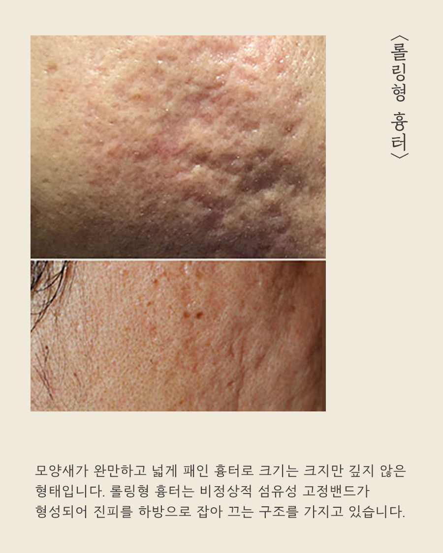 [목동점] 여드름 흉터가 반복되는 내부적·외부적 원인은 무엇인가요? - 해율한의원