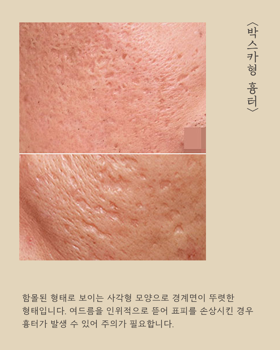 [목동점] 여드름 흉터가 반복되는 내부적·외부적 원인은 무엇인가요? - 해율한의원