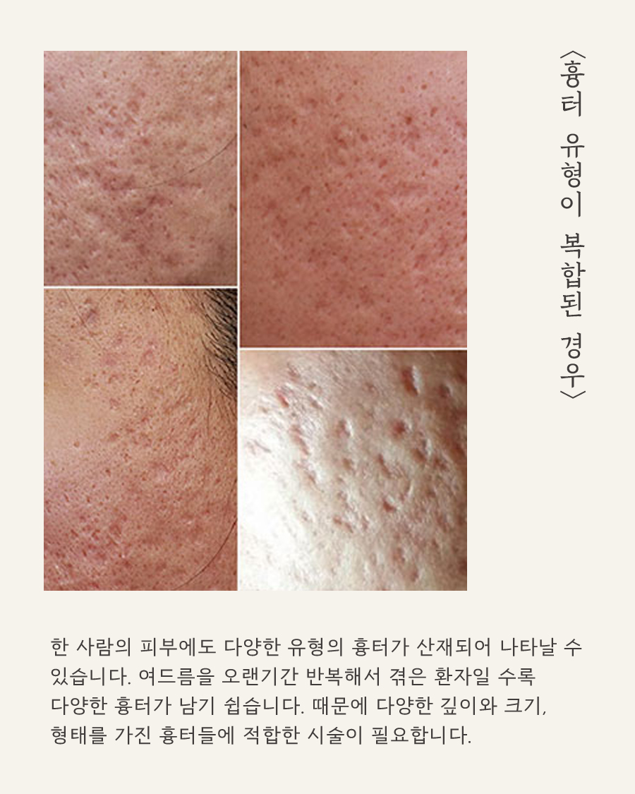 [목동점] 목동여드름흉터는 왜 생기게 되나요? - 해율한의원