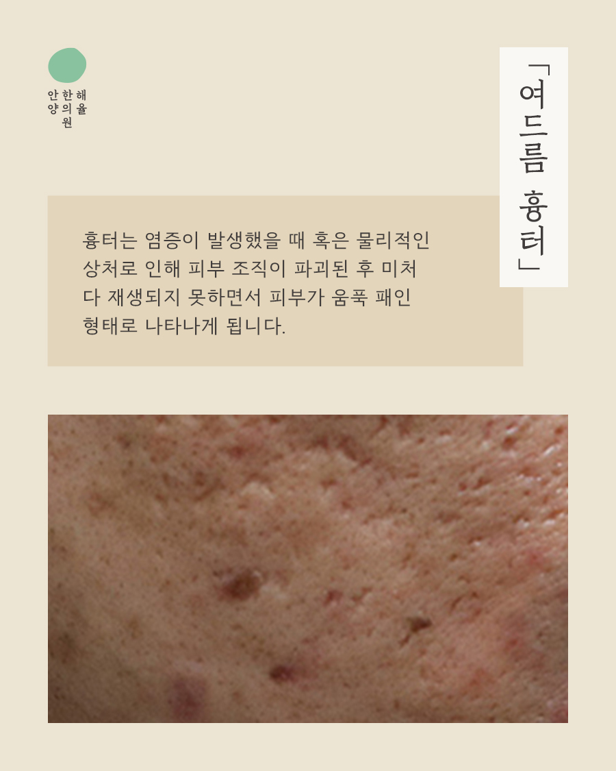 [안양점] 안양새살침 오래된 여드름 흉터도 치료 가능할까요? - 해율한의원