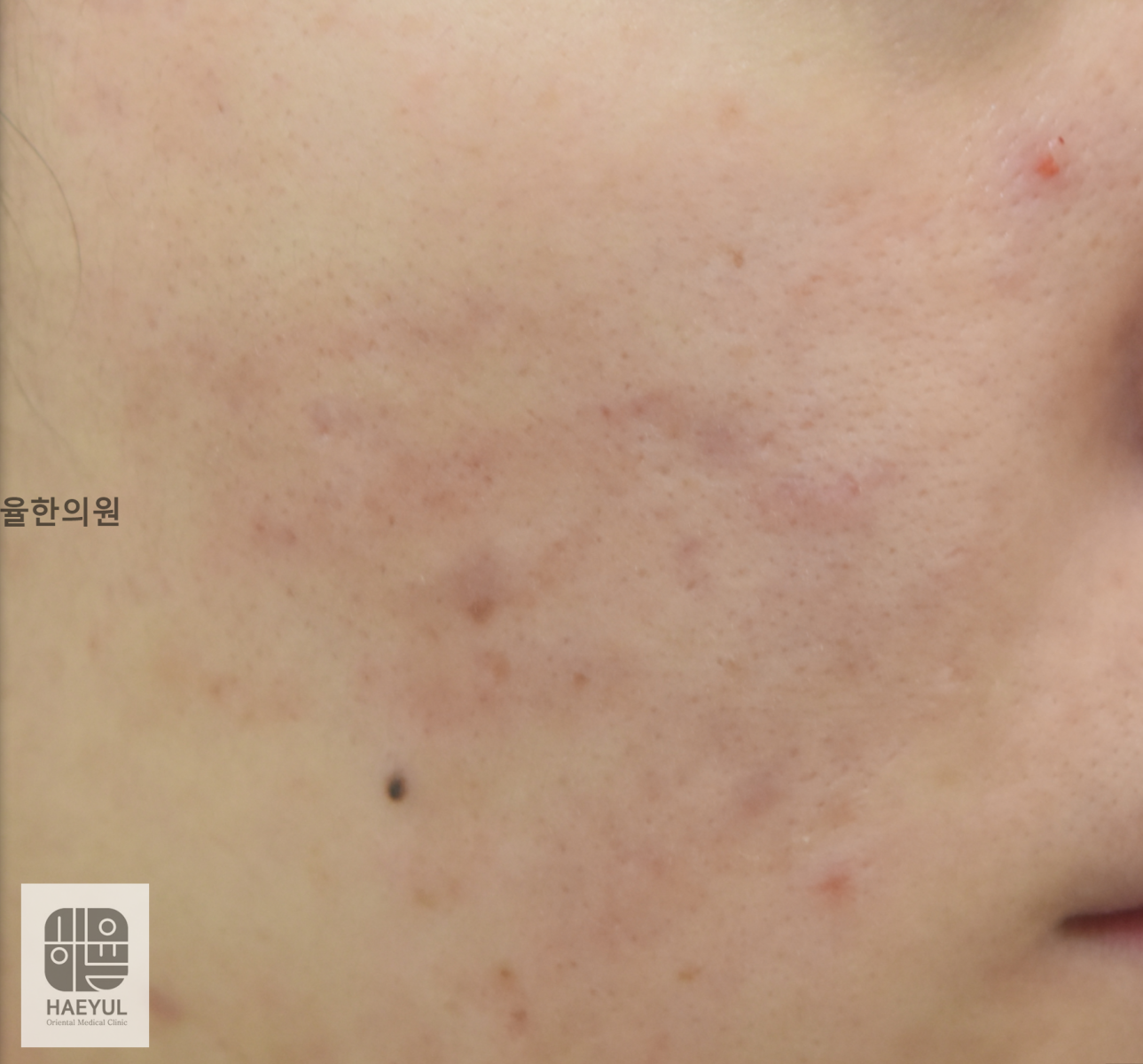 [강남점] 강남여드름흉터 패인 피부가 저절로 차오르지 않는 이유 - 해율한의원