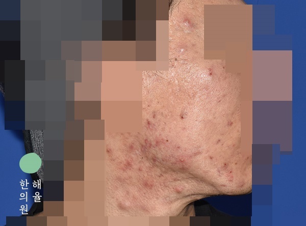 [울산점] 울산여드름한의원 턱과 볼에 반복되는 여드름 고민이라면? - 해율한의원