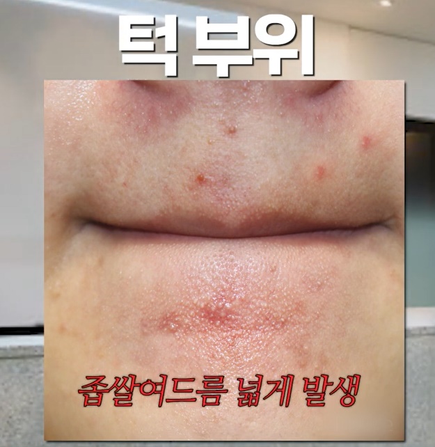 [울산점] 울산여드름한의원 좁쌀여드름 치료 방법 - 해율한의원