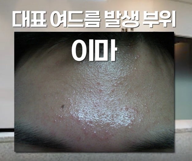 [울산점] 울산여드름한의원 좁쌀여드름 치료 방법 - 해율한의원