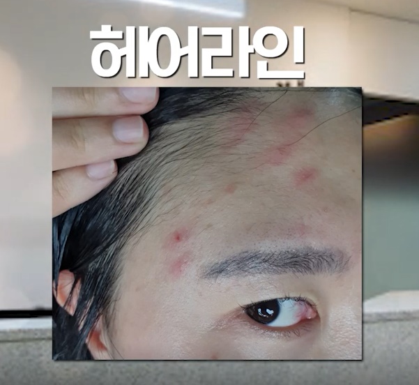 [울산점] 울산여드름한의원 좁쌀여드름 치료 방법 - 해율한의원