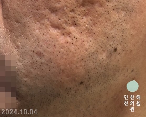 [인천점] 인천새살침 흉터 모양에 따라 치료방법도 달라지나요? - 해율한의원
