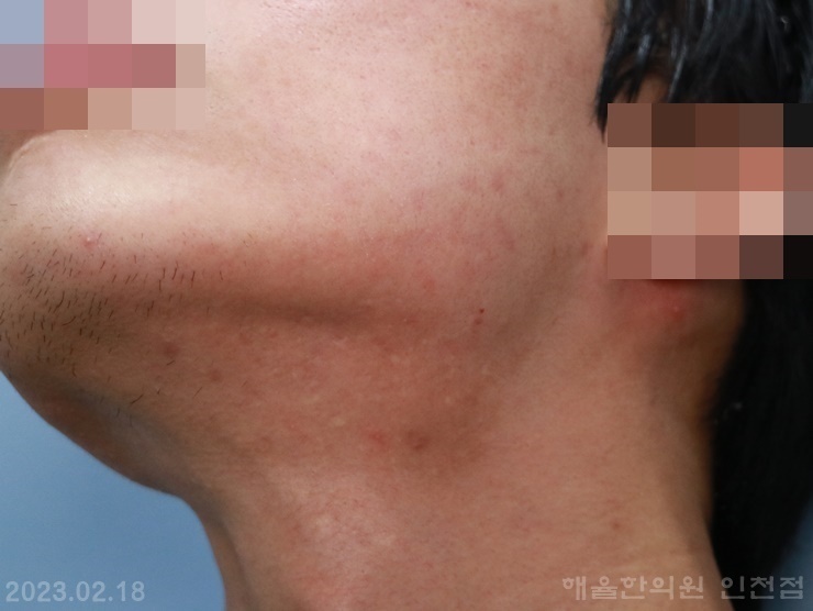 [인천점] 인천여드름한의원 턱선을 따라 트러블이 올라오는 이유는? - 해율한의원