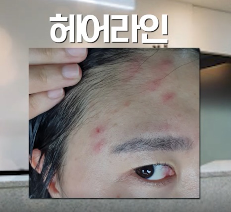 [인천점] 인천피부한의원 좁쌀여드름 방치하면 안되는 이유는? - 해율한의원