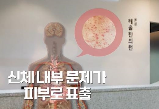 [인천점] 인천피부한의원 좁쌀여드름 방치하면 안되는 이유는? - 해율한의원