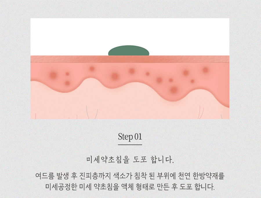 [안산점] 안산여드름자국 오래 남는 이유와 관리법, 원장님이 설명드립니다 - 해율한의원