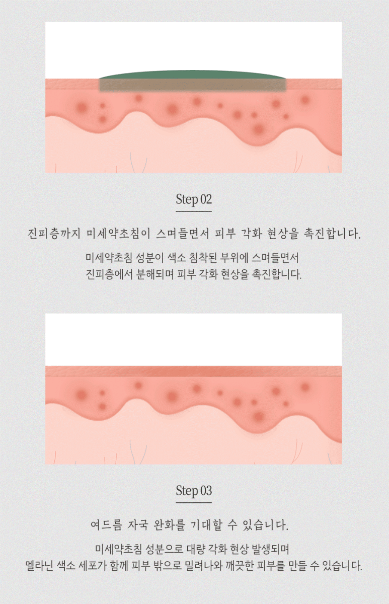 [수원점] 수원여드름자국 미세약초침 치료 후 주의해야 하는 부분은? - 해율한의원