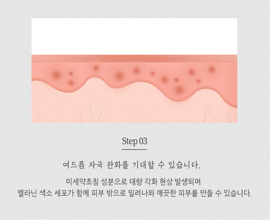 [안산점] 안산여드름자국 오래 남는 이유와 관리법, 원장님이 설명드립니다 - 해율한의원