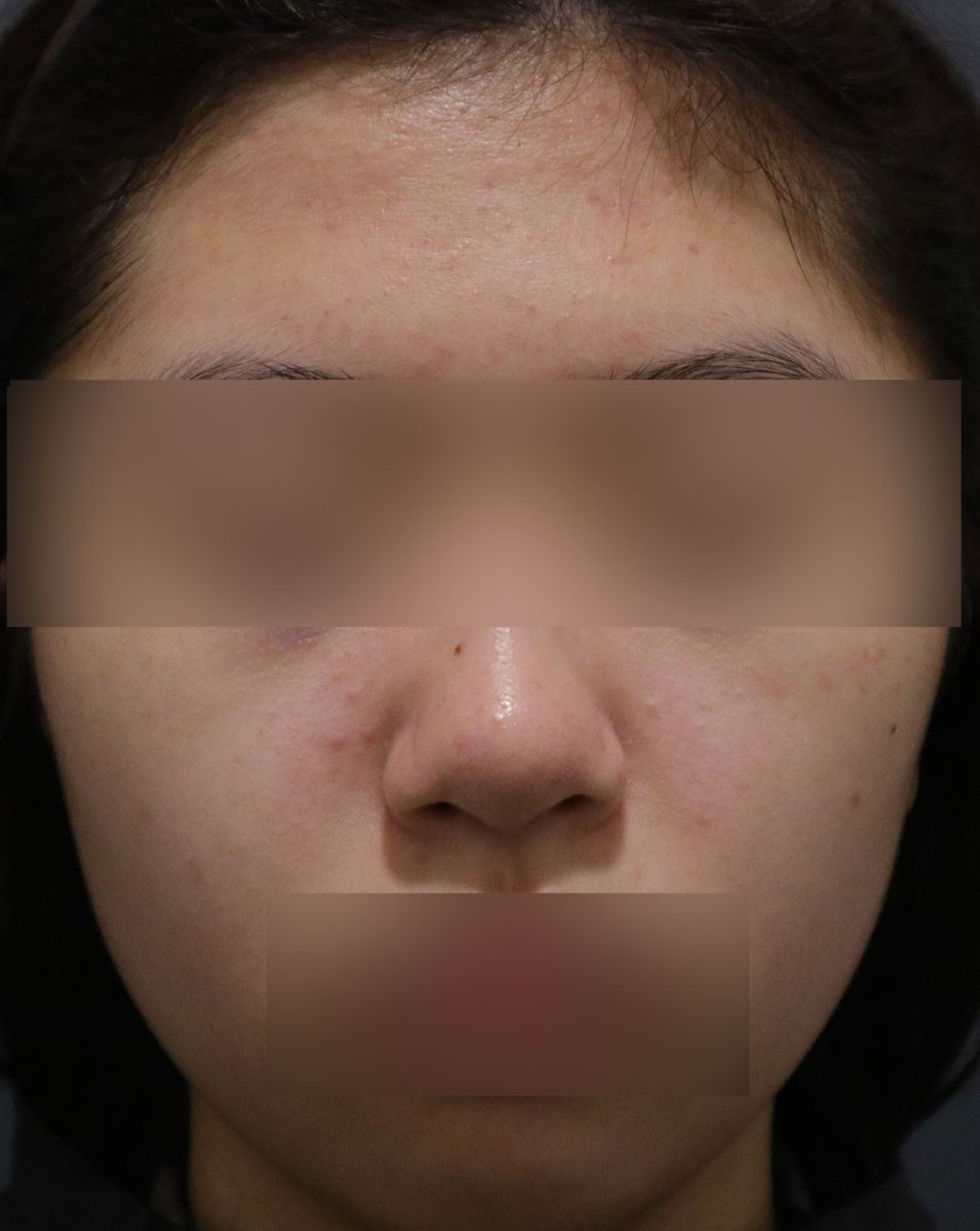 좁쌀 몇 개 정도의 가벼운 면포성 여드름을 보여주는 사진