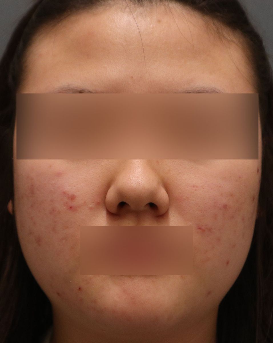 붉은 염증성 여드름이 여러 개 섞인 피부 상태를 보여주는 사진