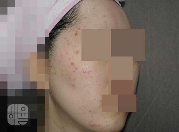 [홍대점] 좁쌀여드름압출 원장직접, 무작정 짜면 안 되는 이유 홍대 해율한의원에서 알려드립니다 - 해율한의원