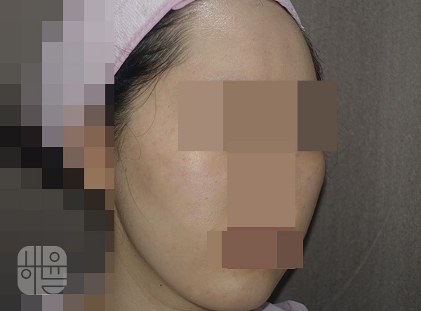 [홍대점] 좁쌀여드름압출 원장직접, 무작정 짜면 안 되는 이유 홍대 해율한의원에서 알려드립니다 - 해율한의원