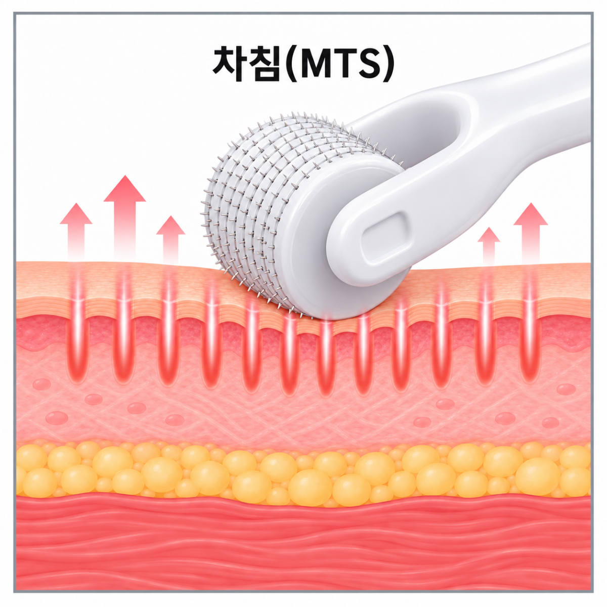 차침의 작용방식을 보여주는 사진