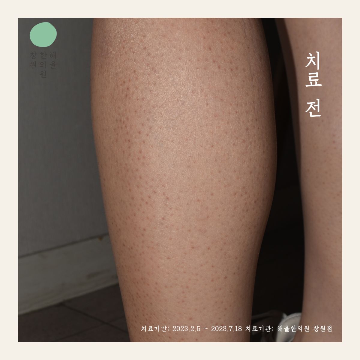 [창원점] 종아리모공각화증과 여드름은 어떻게 다른가요? 창원 해율한의원에서 설명드립니다 - 해율한의원