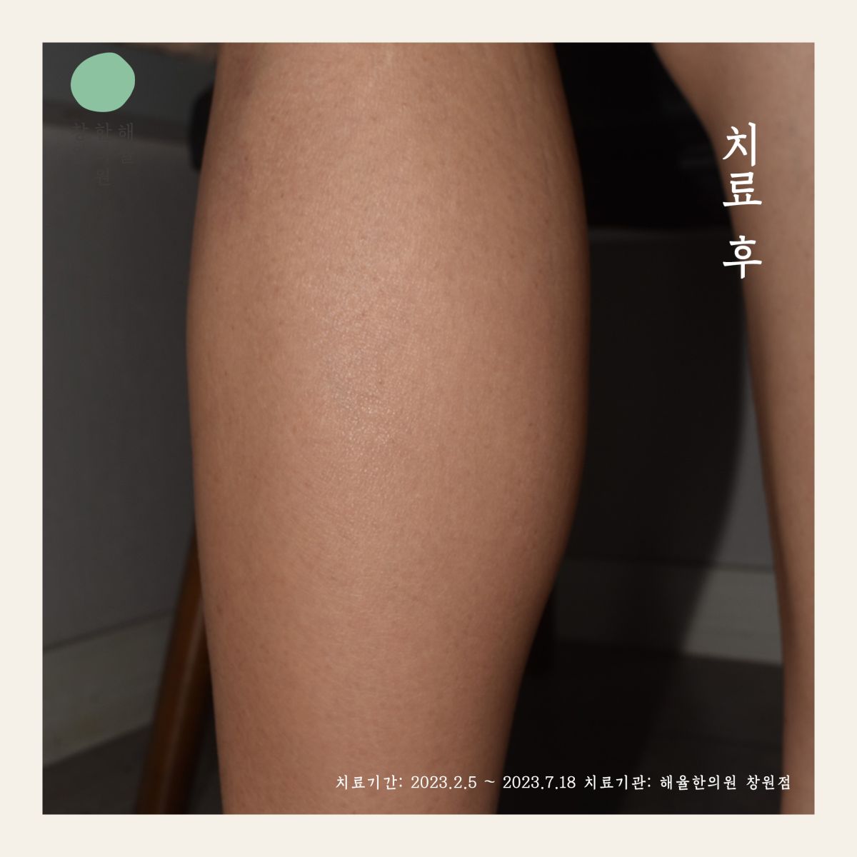 [창원점] 종아리모공각화증과 여드름은 어떻게 다른가요? 창원 해율한의원에서 설명드립니다 - 해율한의원