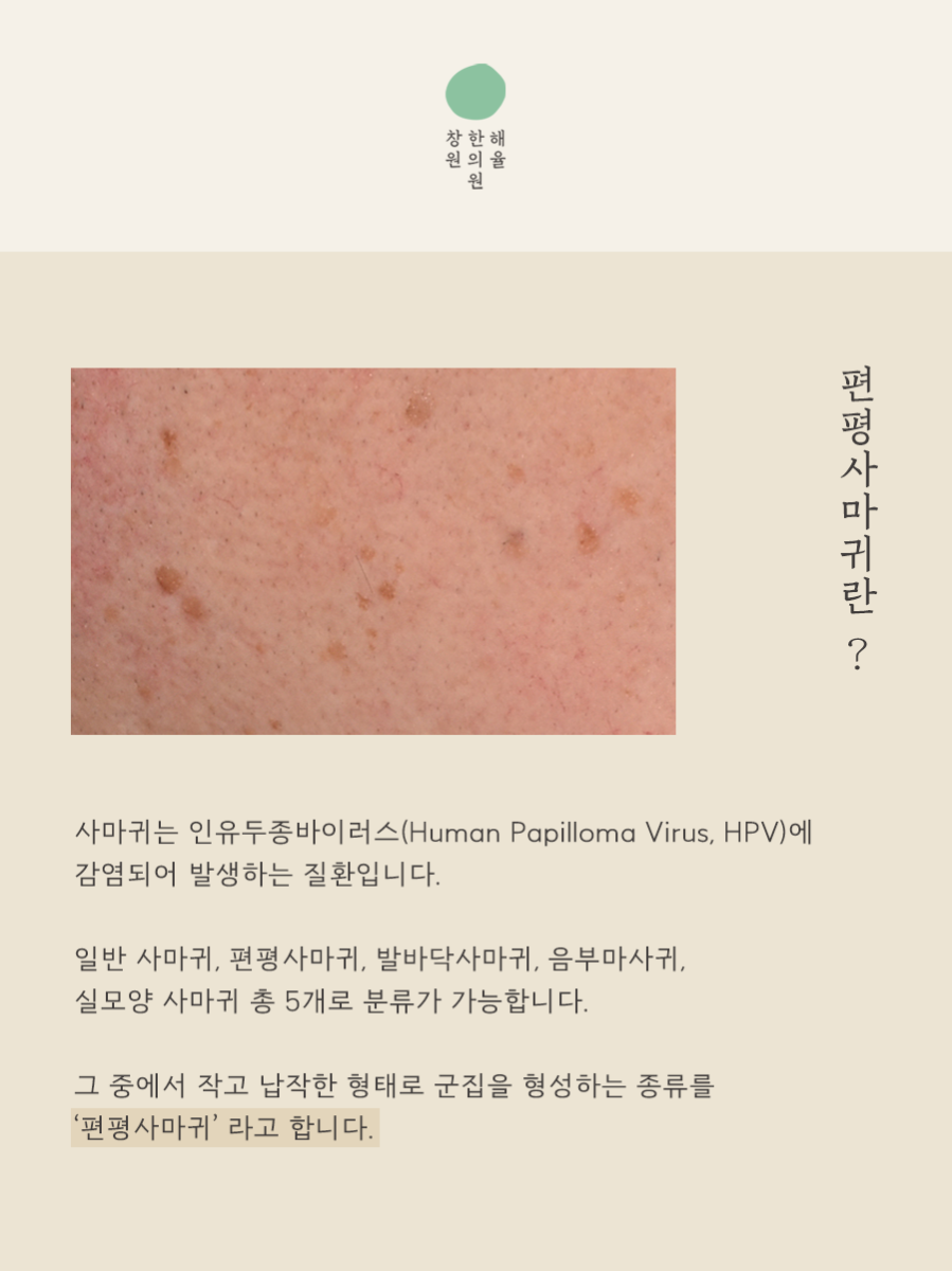 [창원점] 창원편평사마귀 제거 후 딱지와 붉은기는 어떻게 관리할까? - 해율한의원
