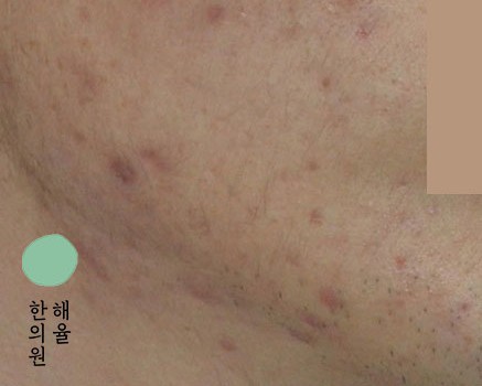 [천안점] 천안여드름자국 미세약초침 원리 및 효과에 대해 설명드립니다 - 해율한의원