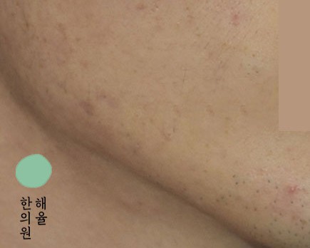 [천안점] 천안여드름자국 미세약초침 원리 및 효과에 대해 설명드립니다 - 해율한의원