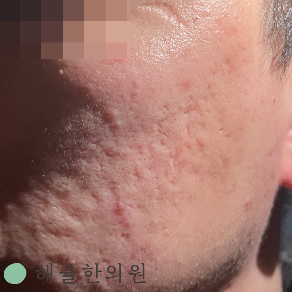 [수원점] 여드름흉터치료 무조건 빨리 시작할수록 좋은가요? - 해율한의원
