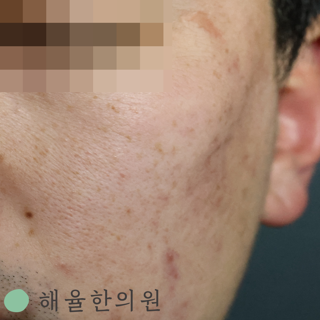 [수원점] 여드름흉터치료 무조건 빨리 시작할수록 좋은가요? - 해율한의원