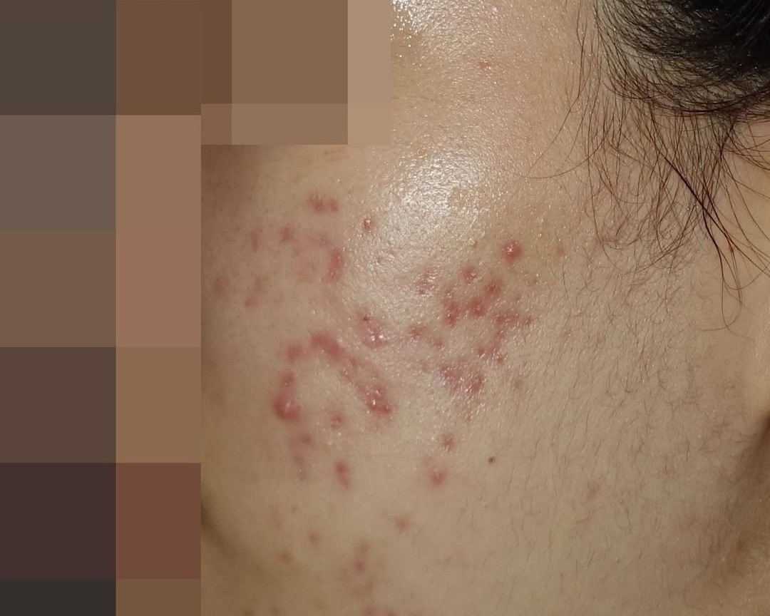 [홍대점] 홍대여드름흉터 어떤 방법으로 치료하나요? - 해율한의원