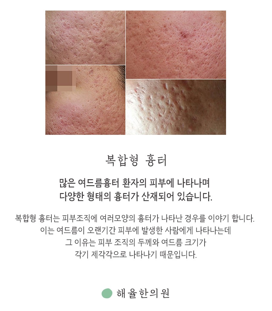 [창원점] 창원여드름흉터 오래된 것도 치료할 수 있을까요? - 해율한의원