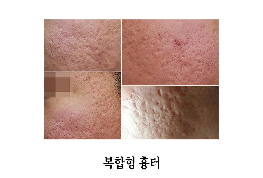 [안산점] 안산새살침 시술의 원리와 특징 알아봐요 - 해율한의원