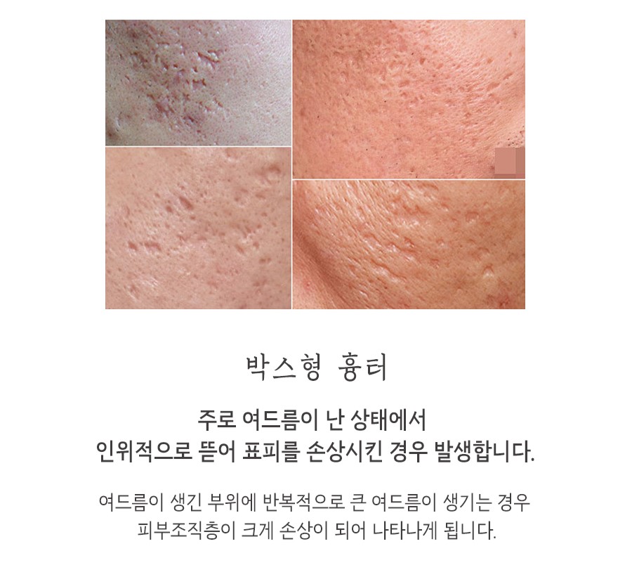 [광주점] 여드름흉터 시간 지나면 자연스럽게 없어질까요? 광주해율한의원에서 알려드립니다 - 해율한의원