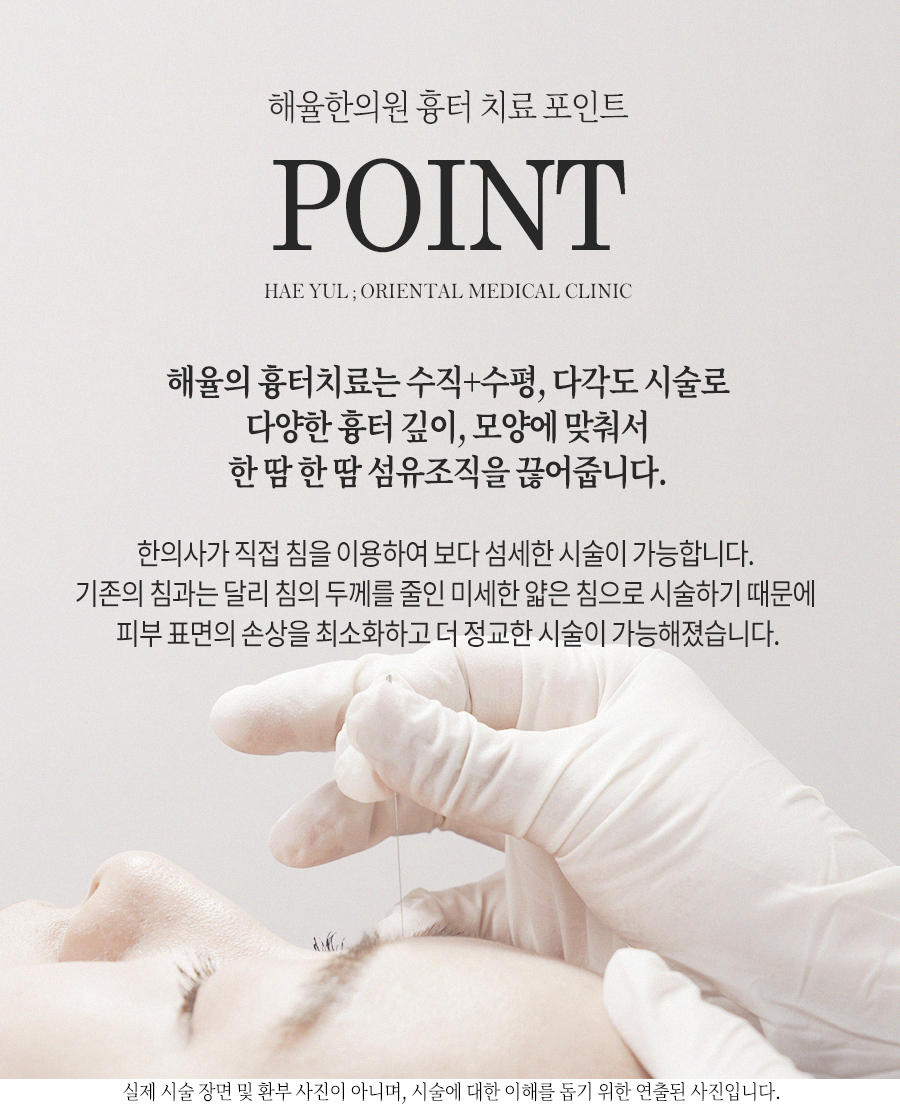 [안산점] 안산새살침 시술의 원리와 특징 알아봐요 - 해율한의원