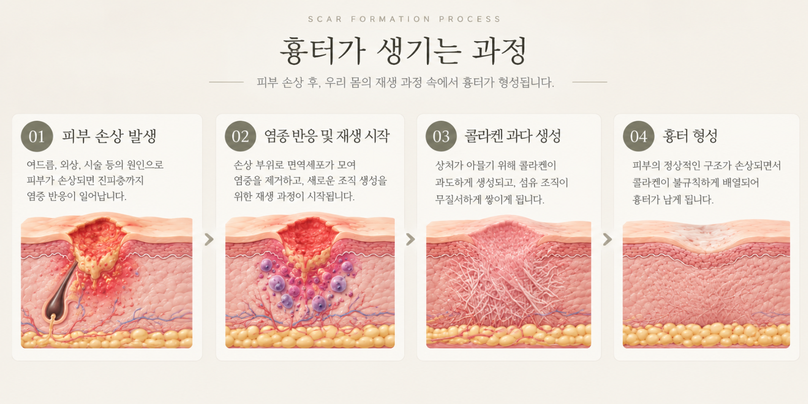 [수원점] 새살침으로 올라온 흉터 다시 꺼지진 않나요? - 해율한의원