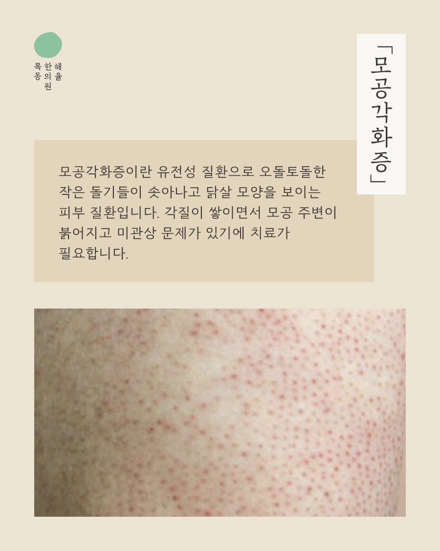 [목동점] 모공각화증 각질 제거로 사라지지 않는 이유, 목동 해율한의원이 설명드립니다 - 해율한의원