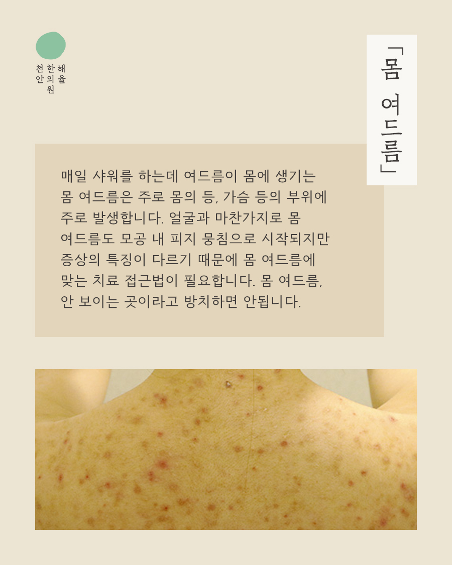 [천안점] 등가슴여드름치료 한의원에서는 어떻게 살펴보나요? 천안 해율한의원에서 설명드립니다 - 해율한의원