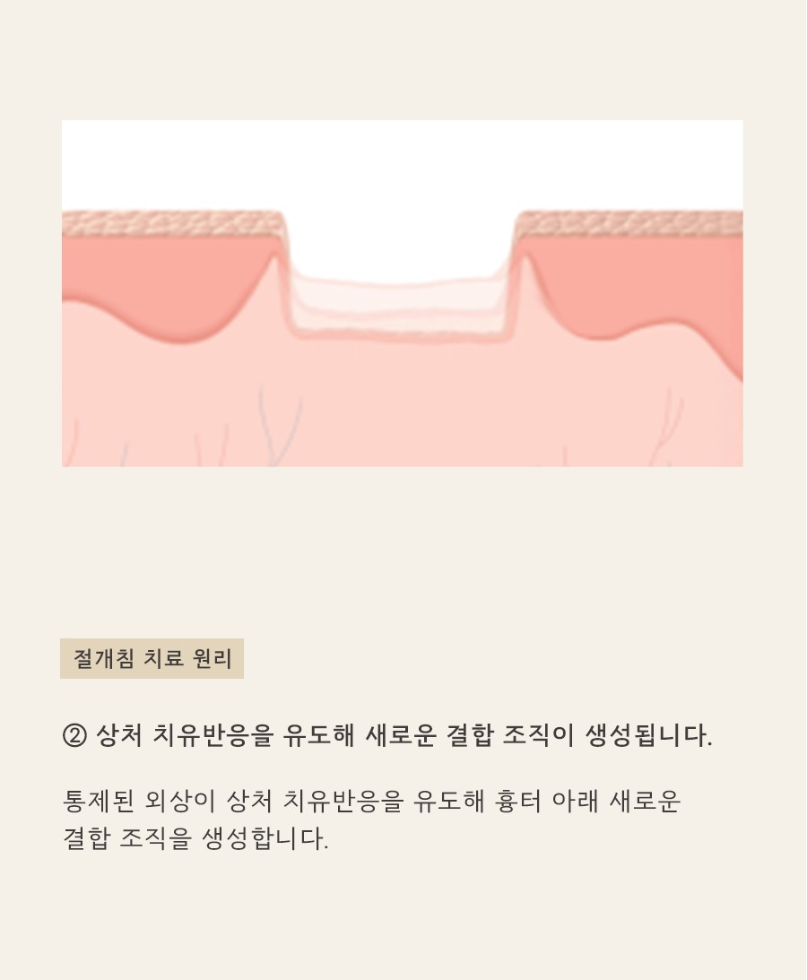 [천안점] 천안여드름흉터 vs 자국 차이점과 치료방법은? - 해율한의원