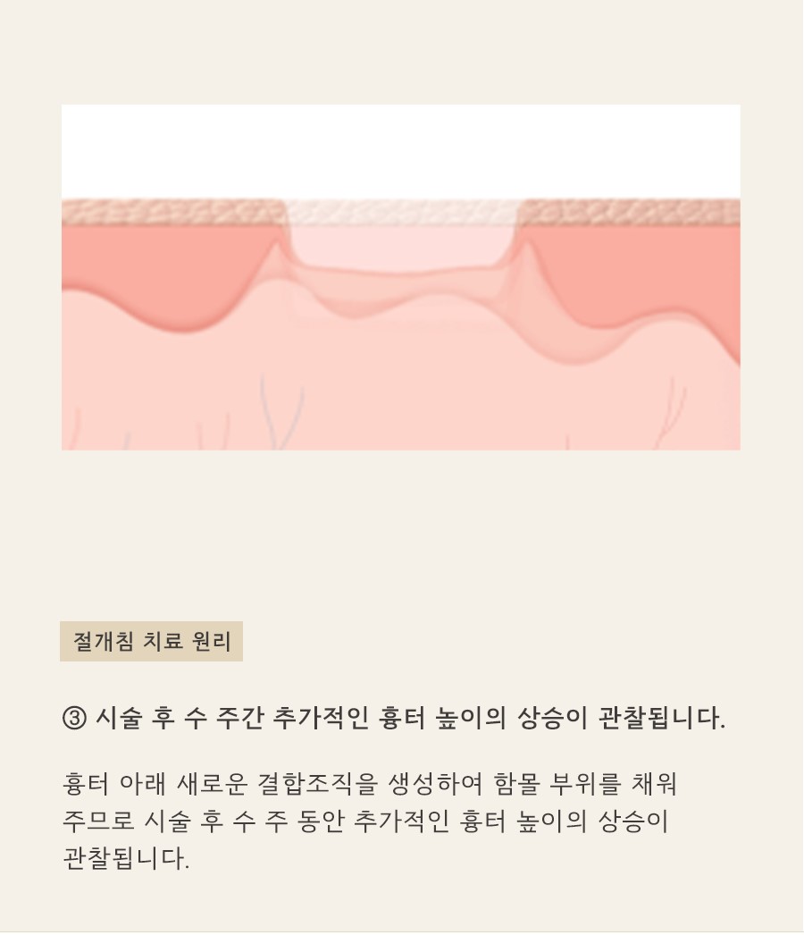 [천안점] 천안여드름흉터 vs 자국 차이점과 치료방법은? - 해율한의원