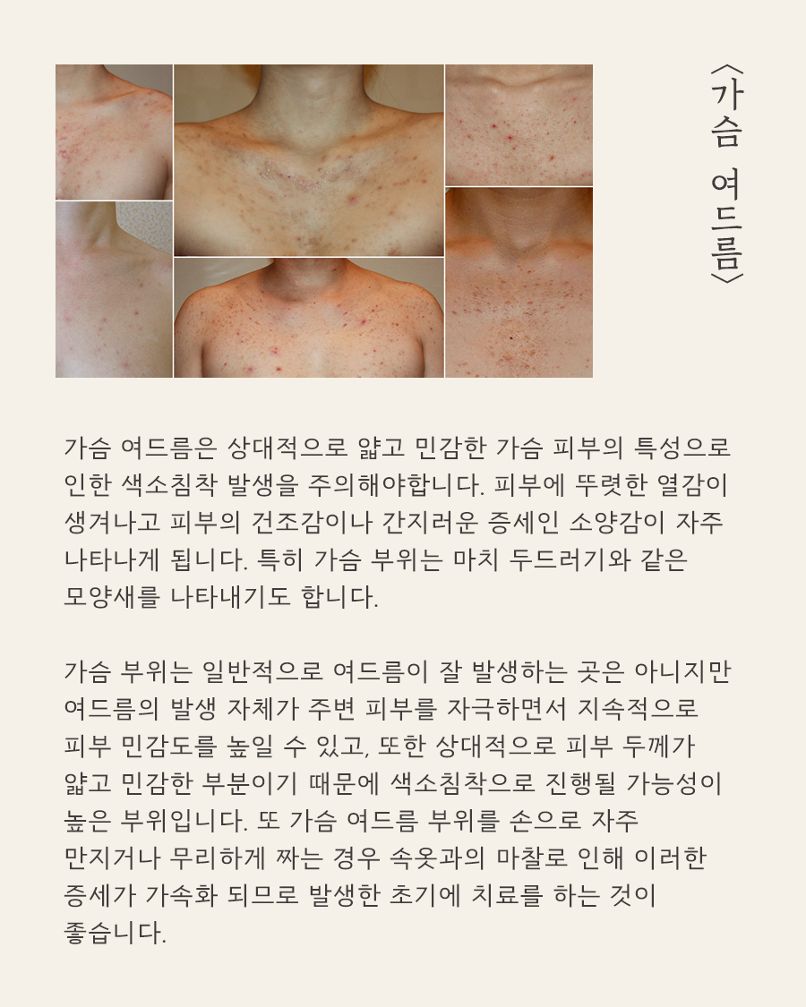 [천안점] 등가슴여드름치료 한의원에서는 어떻게 살펴보나요? 천안 해율한의원에서 설명드립니다 - 해율한의원