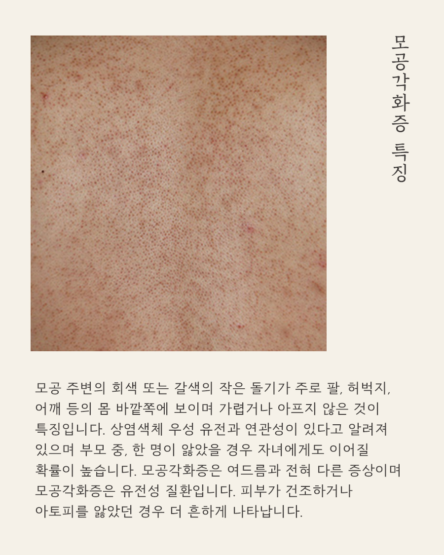 [수원점] 모공각화증 과연 일시적인 현상일까요?수원해율한의원 치료 방법 - 해율한의원