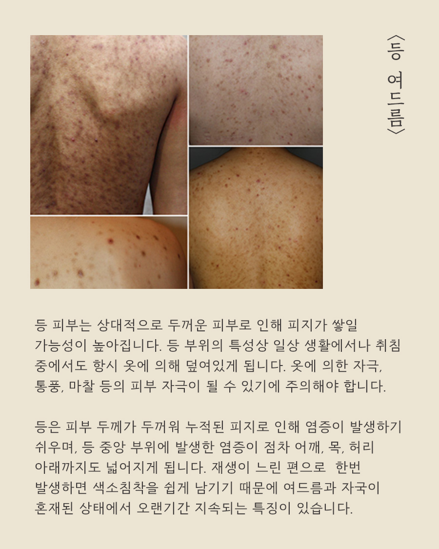 [천안점] 가슴여드름 가드름 색소 침착, 자국 남는 이유는? 천안 해율한의원에서 설명드립니다 - 해율한의원